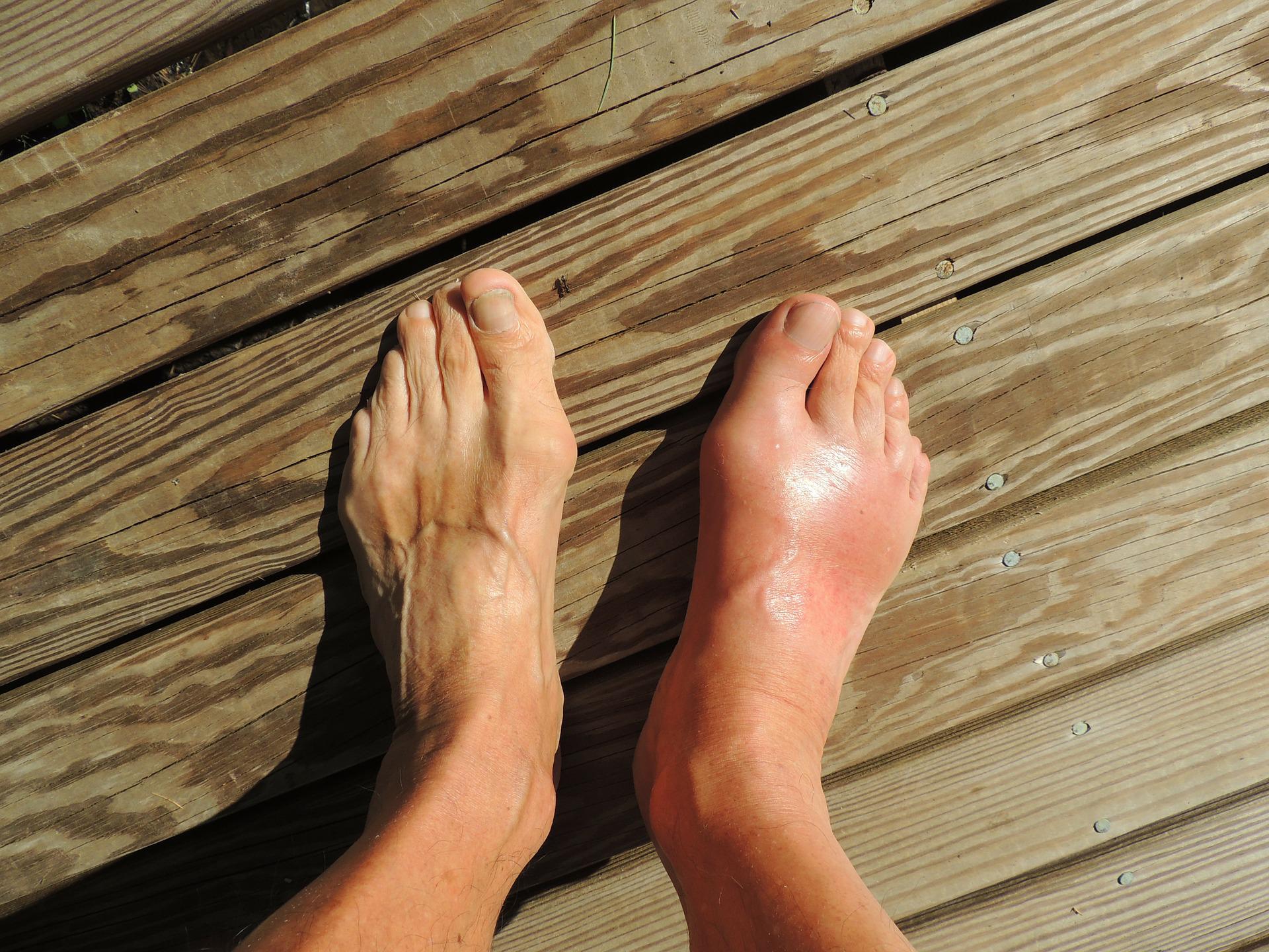 What Foods Are Gout Triggers and What Helps Prevent Gout Flare-Ups?