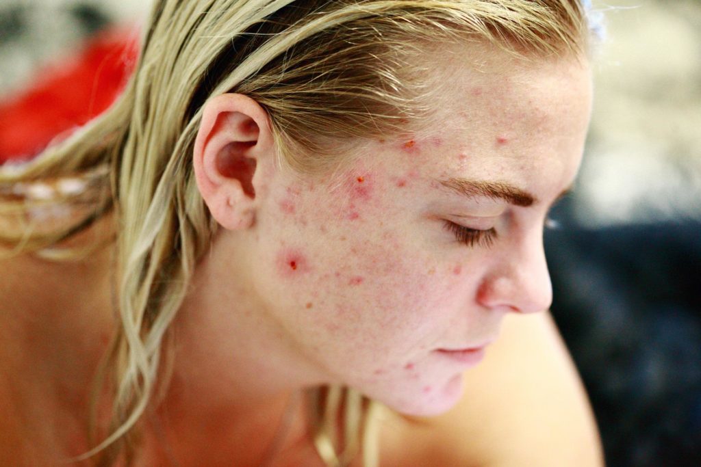 10 Home Remedies for Rosacea