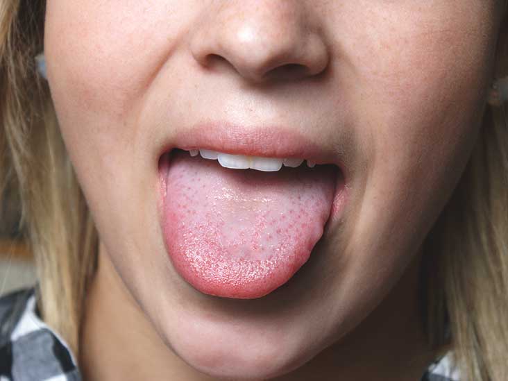 causes of a sore tongue