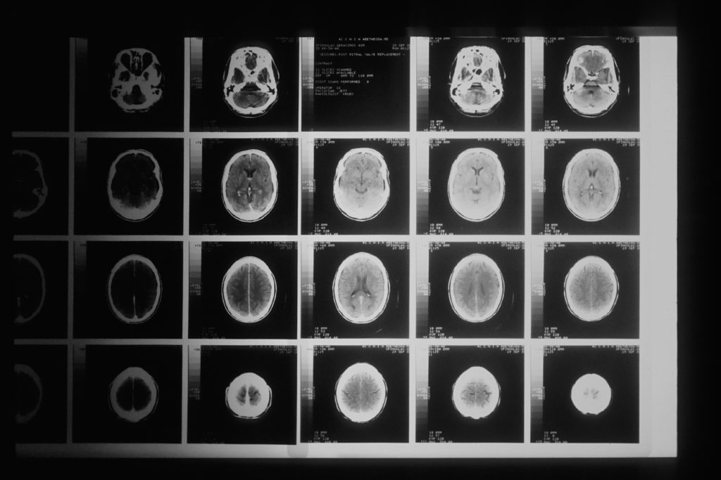 Diagnosis Of MSA