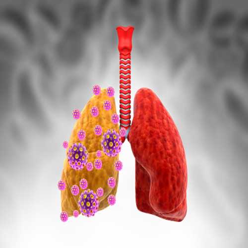 10 causes of pneumonia