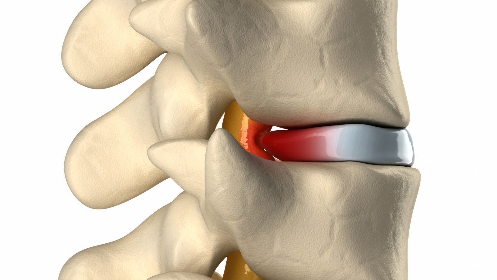 bulging disc in back