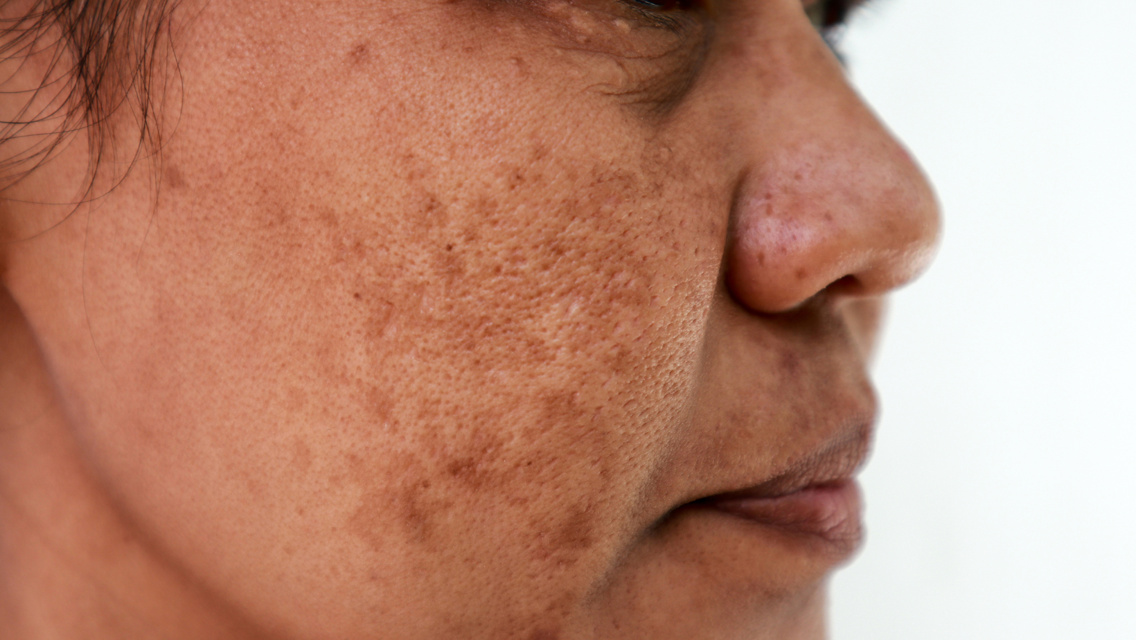 how to remove skin tags