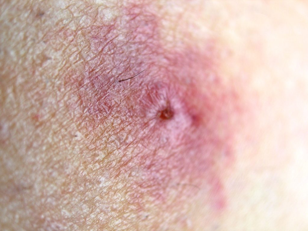 What Are The Signs And Symptoms Of Chigger Bites