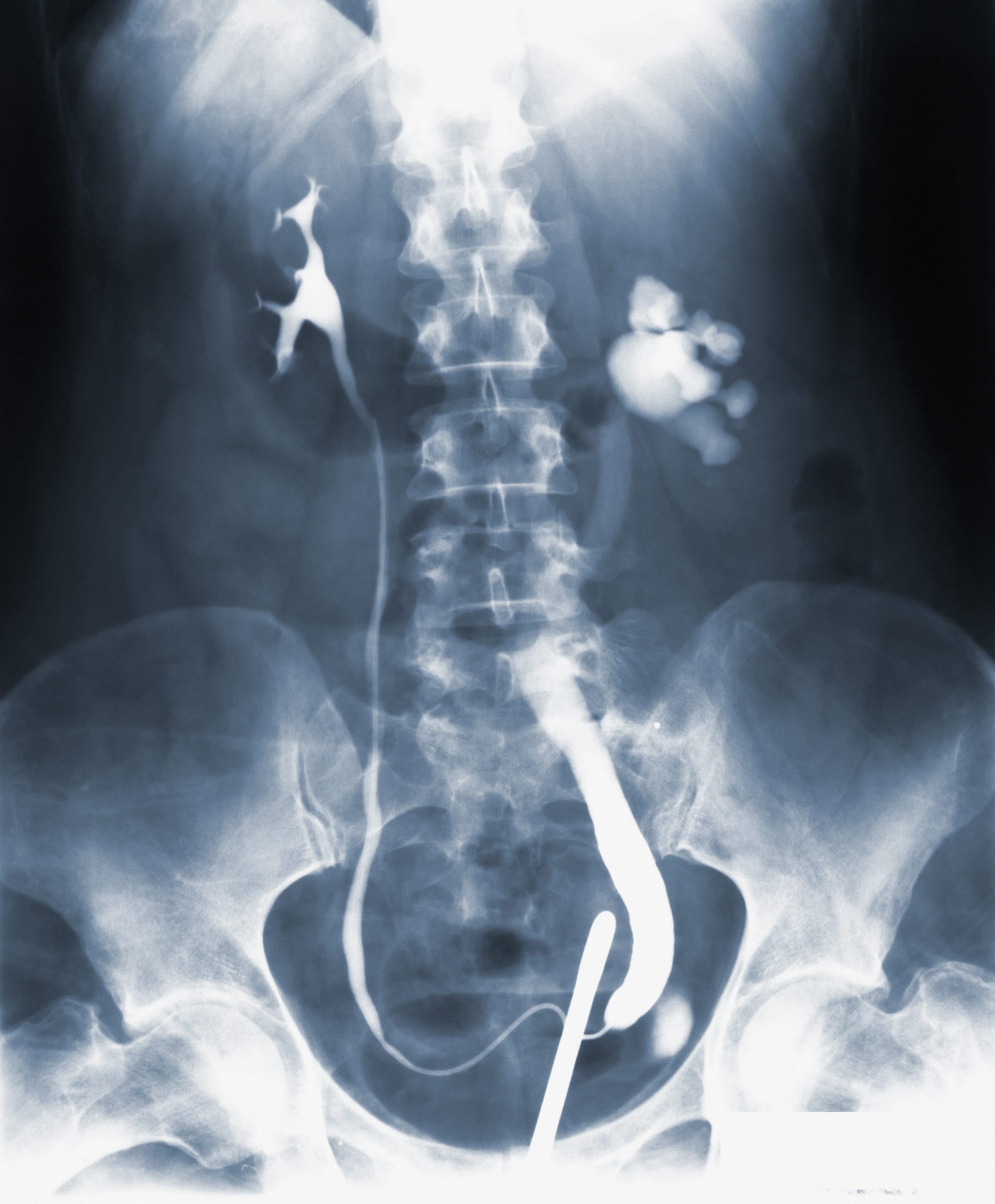 Causes Of Kidney Cysts