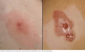 causes of staph infection