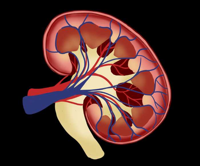 symptoms of kidney stone