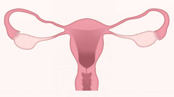 symptoms of ovarian cancer