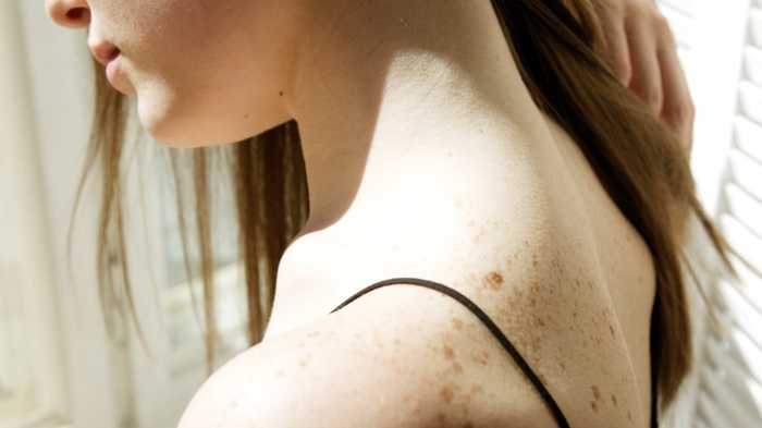 causes of skin tags