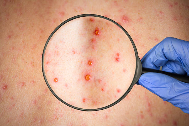 causes of shingles