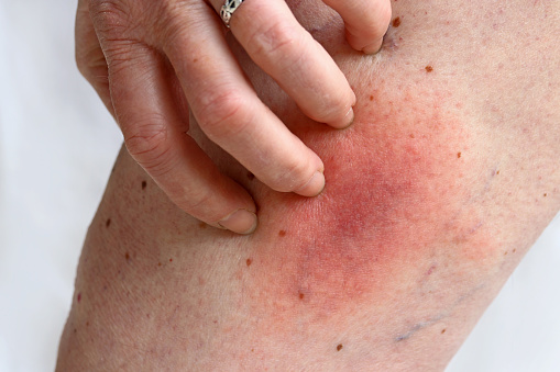symptoms of staph infection