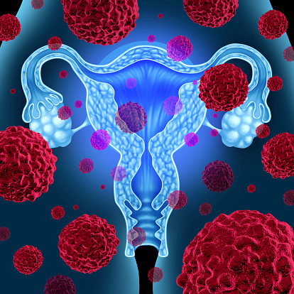 10 Symptoms of Ovarian Cancer