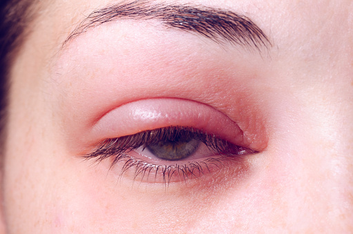 what causes styes
