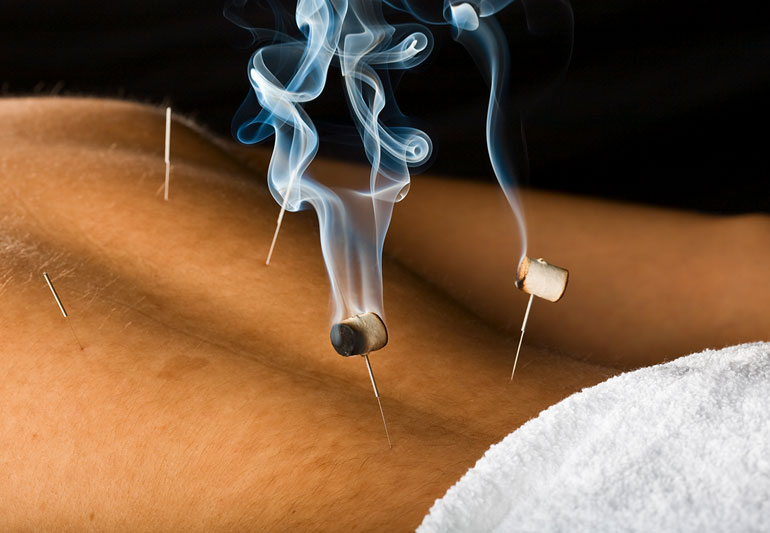 what is moxibustion