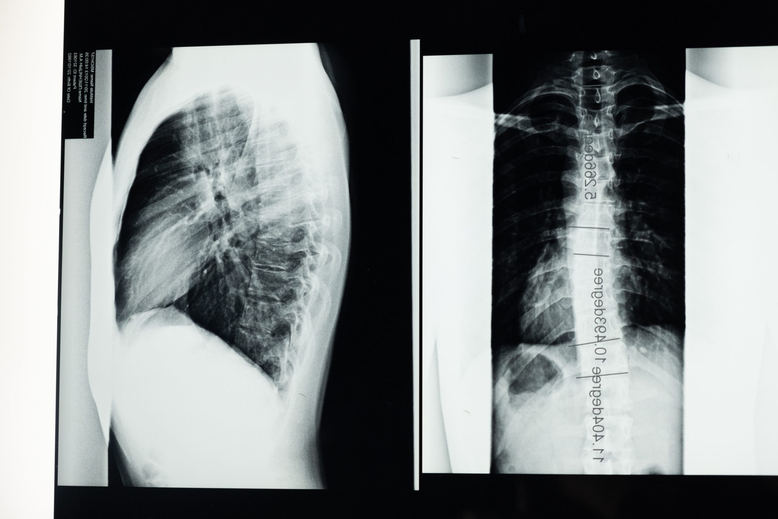Signs and Symptoms of Scoliosis