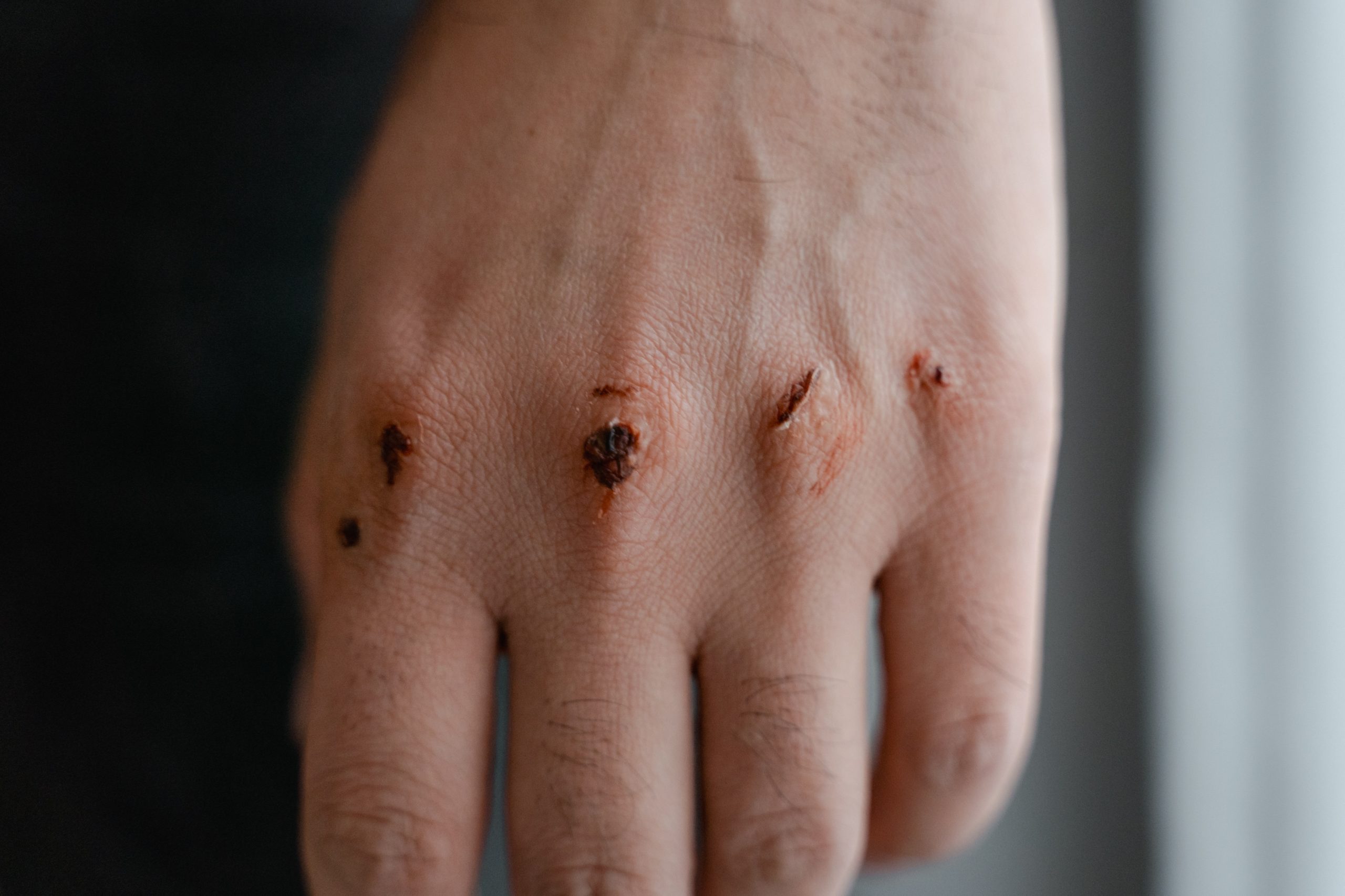 10 Causes of Staph Infection