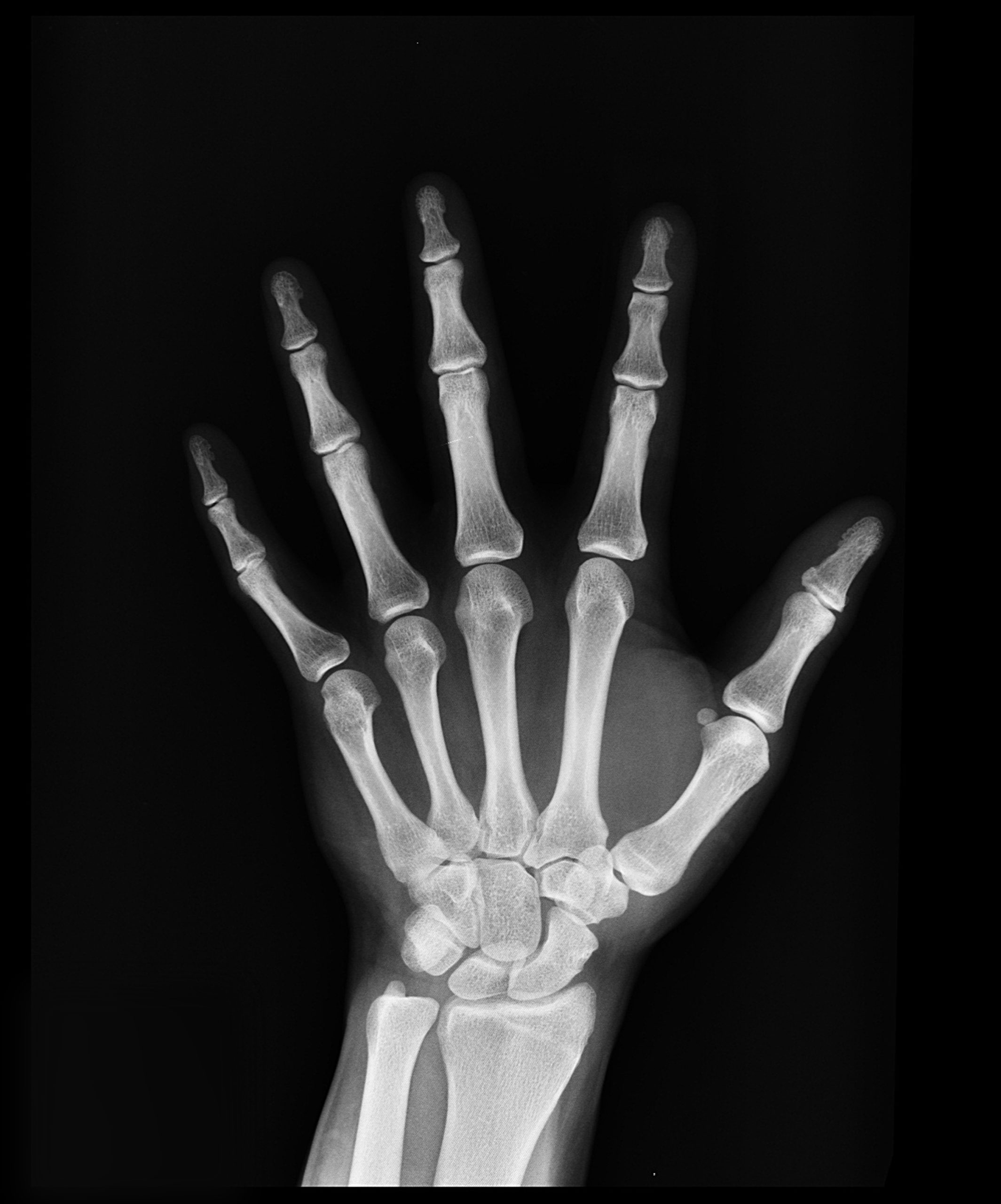 What is Paget's Disease?
