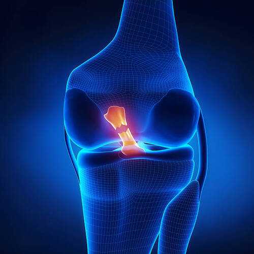 10 frequently asked questions about torn meniscus