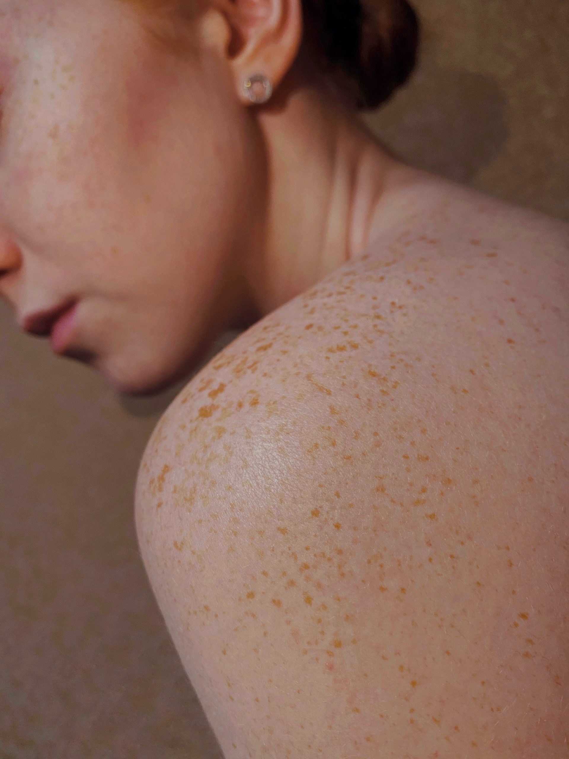Pityriasis Rosea: 10 Symptoms and Treatments